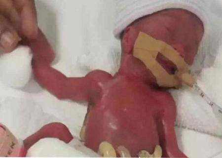 Menor bebê prematuro do mundo recebe alta após 13 meses na UTI