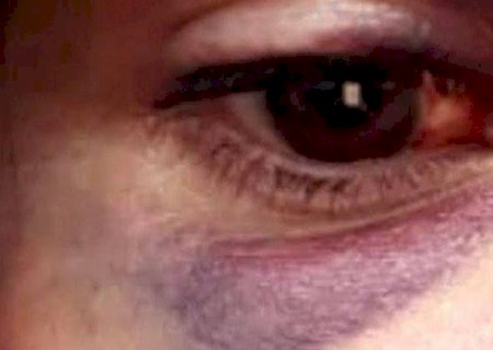 Com lesões após agressões do marido, mulher falta ao trabalho e mobiliza polícia em MS