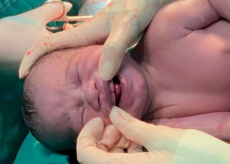 Beb&ecirc; campo-grandense nasce com 6 &lsquo;dentes&rsquo; e surpreende todo mundo