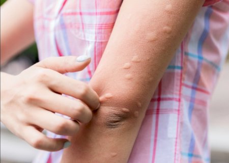 Não é só dengue: picadas de mosquitos também podem causar alergias que duram meses